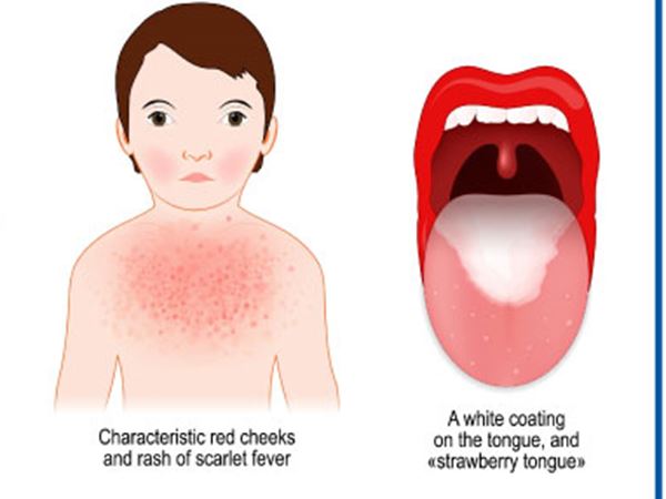 scarlet fever